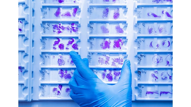 Nuova IA consente un doppio sguardo per le analisi istologiche alla tiroide - sanitainformazione.it